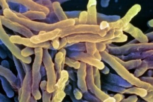 tuberculosis