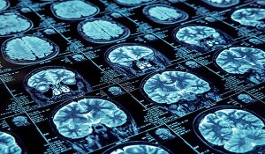 epilepsia